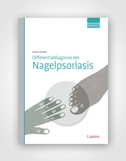 Differentialdiagnose der Nagelpsoriasis